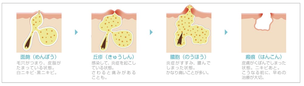 ニキビは早めに治療