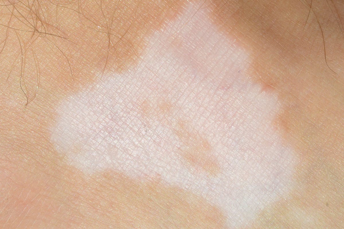 【常見皮膚病】小心猛烈陽光引起敏感，形成「多形性日光疹」。 – Medical Inspire 醫・思維